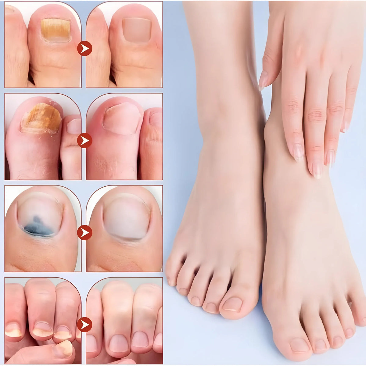 Fungal Nail Patches (Yellow)