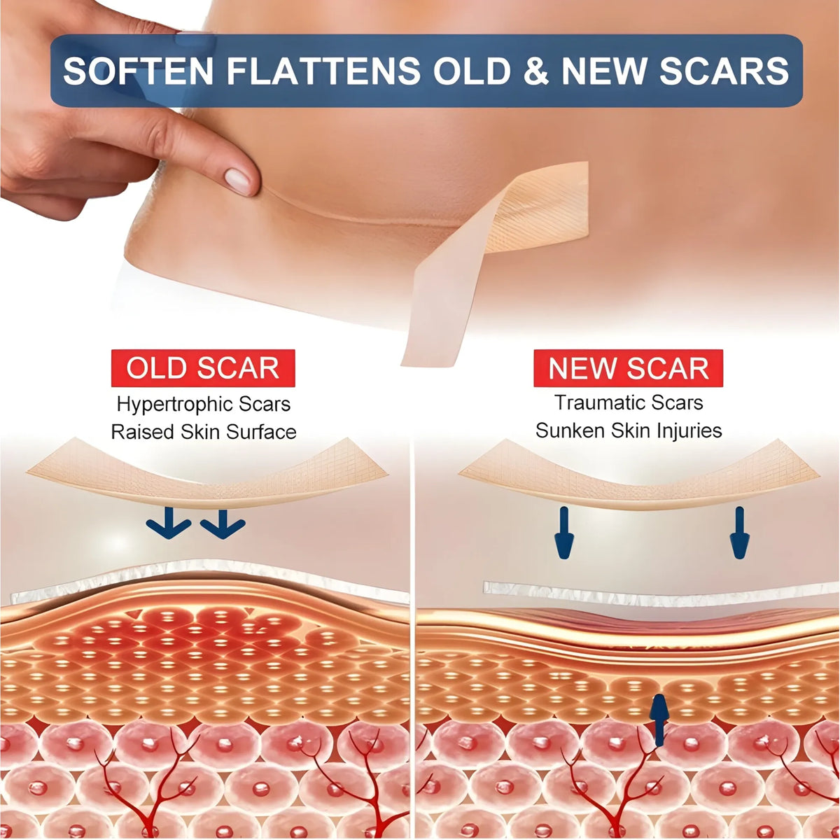 Silicone Scar Tape (Beige)